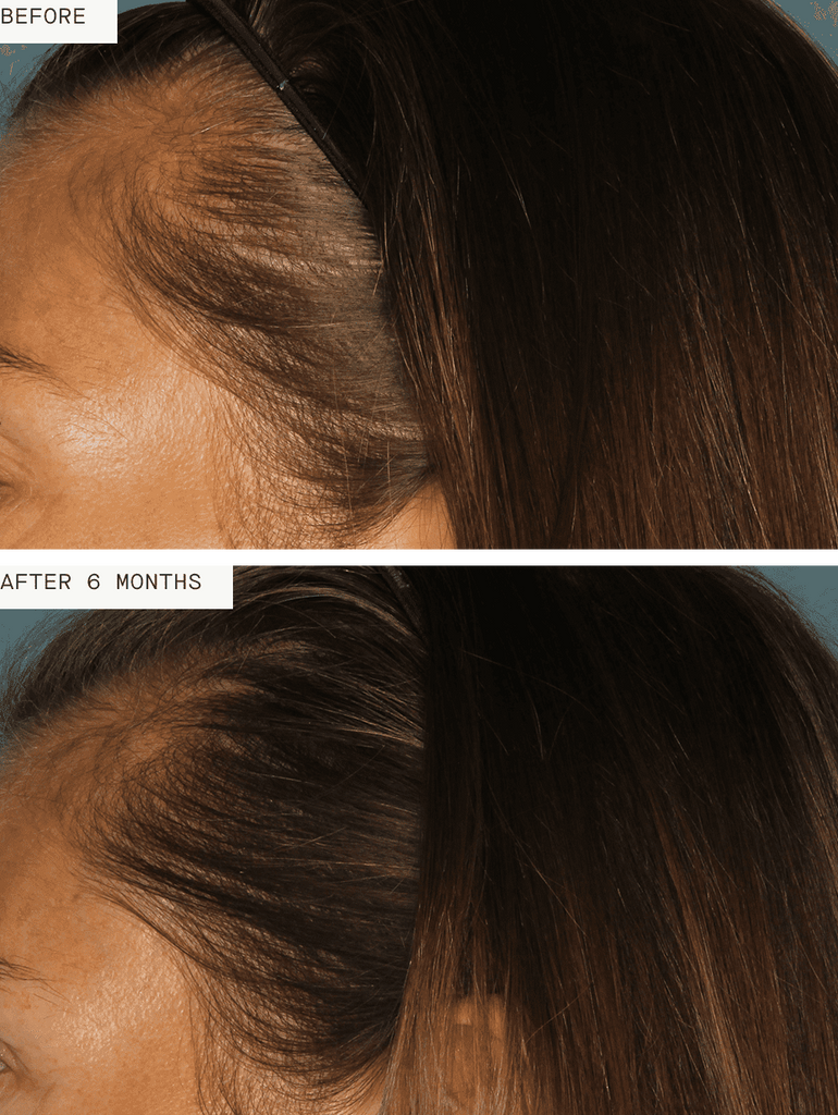 Nutrafol Women | Daily Hair Growth Supplement
